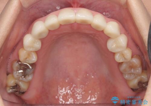 オールセラミッククラウン・セラミックインレー　口腔内全体の見た目の改善の治療後
