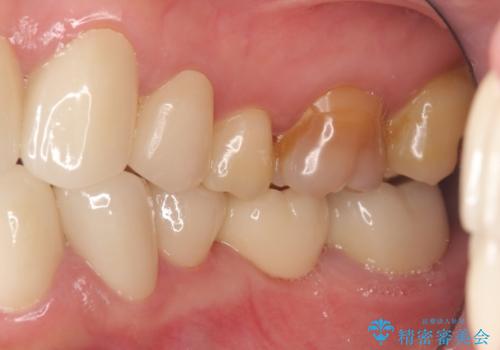 オールセラミッククラウン・セラミックインレー 口腔内全体の見た目の改善の治療後