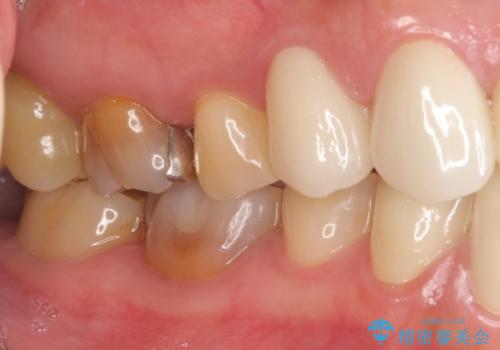 オールセラミッククラウン・セラミックインレー 口腔内全体の見た目の改善の治療後