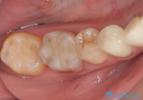 オールセラミッククラウン・セラミックインレー 口腔内全体の見た目の改善の治療後