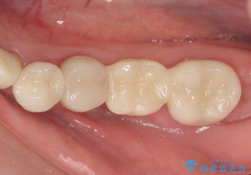 オールセラミッククラウン・セラミックインレー 口腔内全体の見た目の改善の治療後