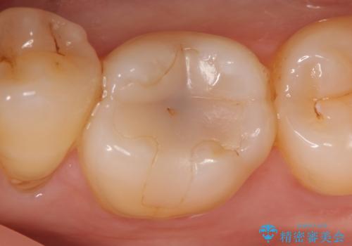 セラミックインレー しみる古い樹脂のやり替えの症例 治療前