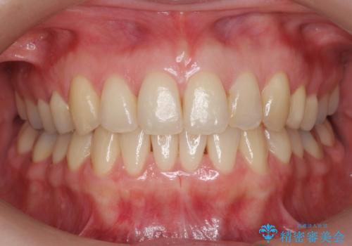 上の前歯が一部引っ込んでいる 下のがたがた マウスピース矯正の症例 治療後