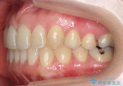 上の前歯が一部引っ込んでいる 下のがたがた マウスピース矯正の治療後