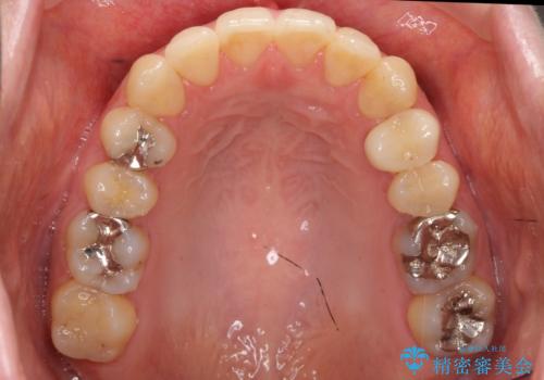 上の前歯が一部引っ込んでいる　下のがたがた　マウスピース矯正の治療後