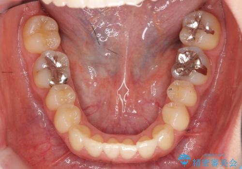 上の前歯が一部引っ込んでいる 下のがたがた マウスピース矯正の治療後