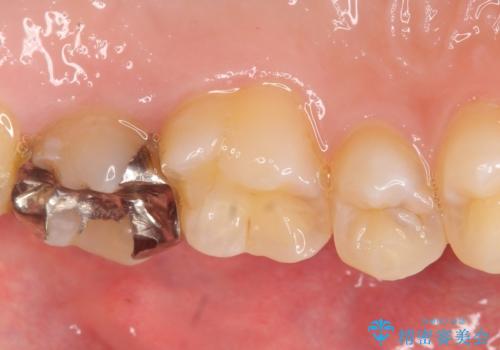 セラミックインレー　虫歯と指摘された奥歯の治療の治療前