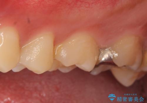セラミックインレー 虫歯と指摘された奥歯の治療の治療前