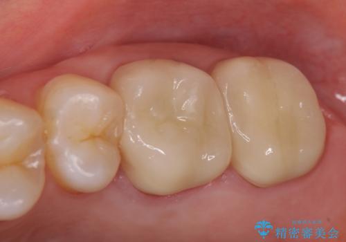 オールセラミッククラウン 疼く奥歯の治療の治療後