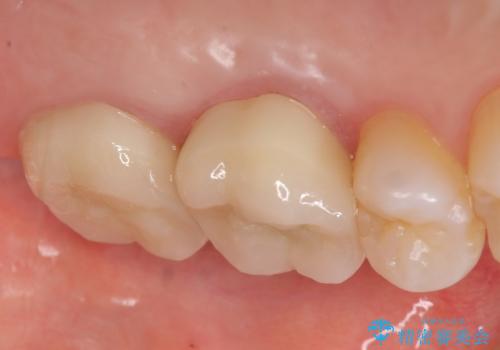 オールセラミッククラウン 疼く奥歯の治療の治療後