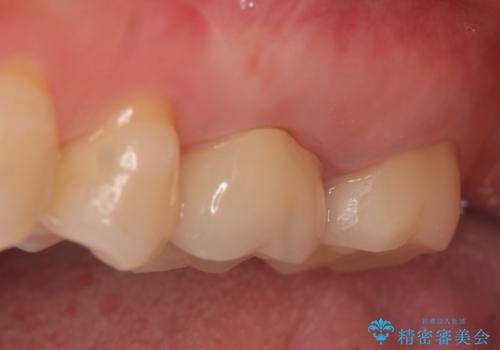オールセラミッククラウン 疼く奥歯の治療