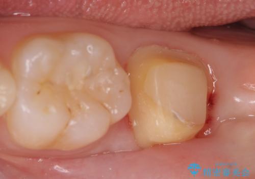 オールセラミッククラウン　奥歯の虫歯・深いポケットの除去の治療中