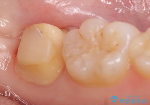 オールセラミッククラウン 奥歯の虫歯・深いポケットの除去の治療中