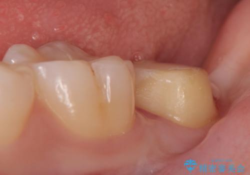 オールセラミッククラウン 奥歯の虫歯・深いポケットの除去の治療中