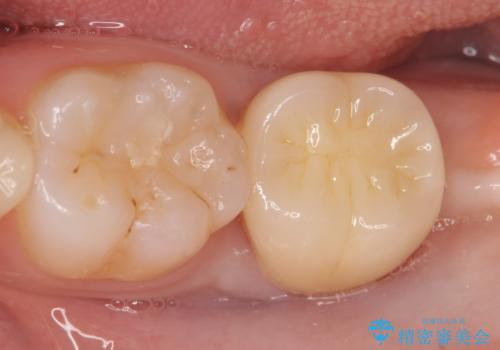 オールセラミッククラウン 奥歯の虫歯・深いポケットの除去