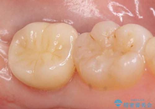 オールセラミッククラウン 奥歯の虫歯・深いポケットの除去の治療後