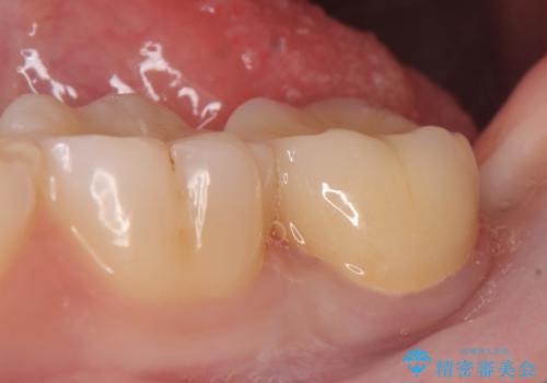 オールセラミッククラウン 奥歯の虫歯・深いポケットの除去の治療後
