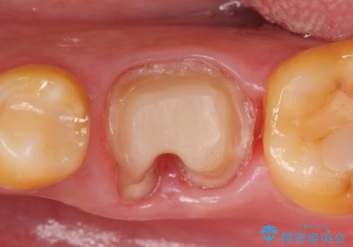 オールセラミッククラウン 他院にて抜歯と言われた歯の治療の治療中