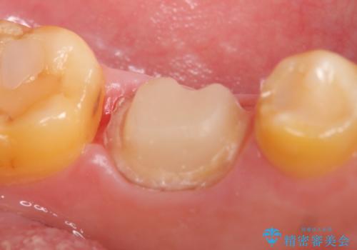 オールセラミッククラウン 他院にて抜歯と言われた歯の治療の治療中