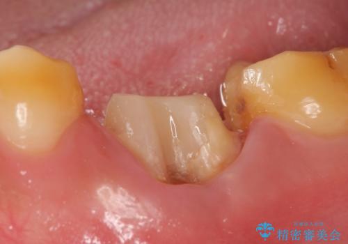 オールセラミッククラウン 他院にて抜歯と言われた歯の治療の治療中