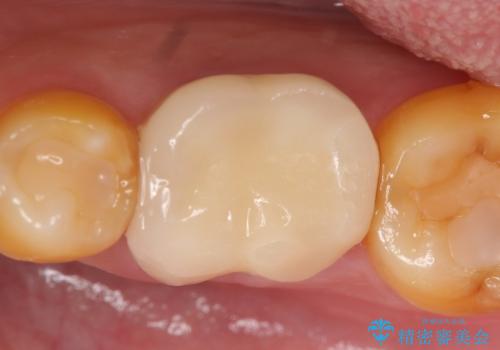 オールセラミッククラウン 他院にて抜歯と言われた歯の治療