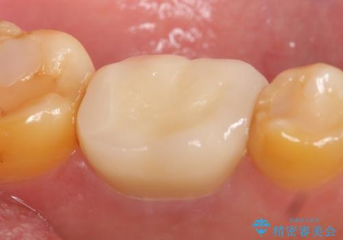 オールセラミッククラウン 他院にて抜歯と言われた歯の治療の治療後