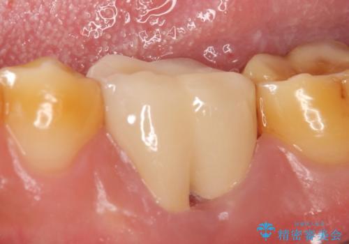 オールセラミッククラウン 他院にて抜歯と言われた歯の治療の症例 治療後
