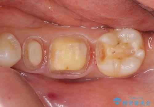 オールセラミッククラウン　セラミックインレー　銀歯を白い歯への治療中