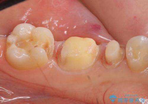 オールセラミッククラウン　セラミックインレー　銀歯を白い歯への治療中