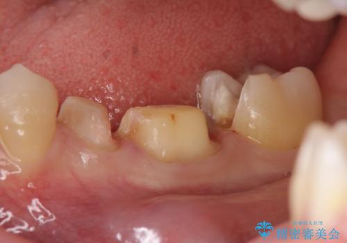 オールセラミッククラウン セラミックインレー 銀歯を白い歯への治療中