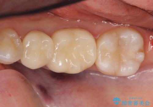 オールセラミッククラウン　セラミックインレー　銀歯を白い歯への症例 治療後