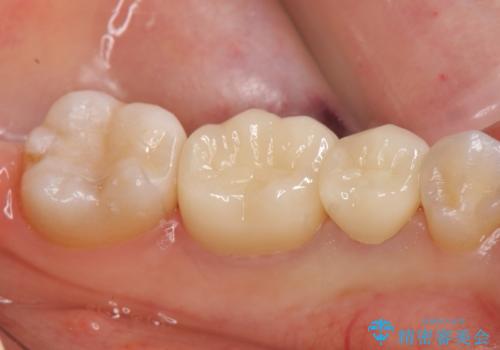 オールセラミッククラウン セラミックインレー 銀歯を白い歯へ