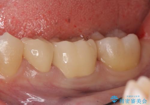 オールセラミッククラウン セラミックインレー 銀歯を白い歯への治療後