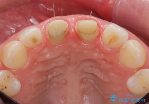 口ゴボでお悩みの方必見! 不自然なセラミックをやり直す矯正 セラミックだけでは、口元は下がりません。の治療後