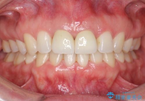 口ゴボでお悩みの方必見! 不自然なセラミックをやり直す矯正 セラミックだけでは、口元は下がりません。の治療後