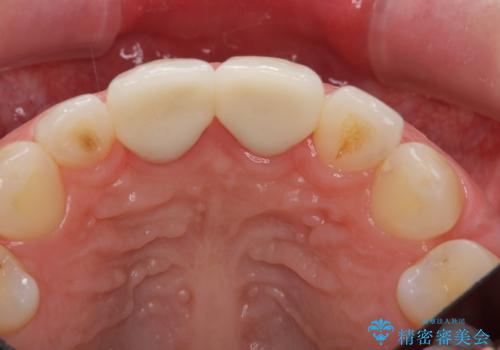 口ゴボでお悩みの方必見! 不自然なセラミックをやり直す矯正 セラミックだけでは、口元は下がりません。の治療後