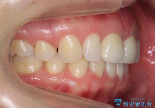 口ゴボでお悩みの方必見! 不自然なセラミックをやり直す矯正 セラミックだけでは、口元は下がりません。の治療後