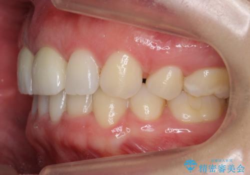 口ゴボでお悩みの方必見! 不自然なセラミックをやり直す矯正 セラミックだけでは、口元は下がりません。の治療後