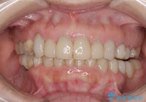 この際全てをしっかりと治療したい 総合歯科治療の治療中