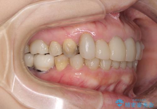 この際全てをしっかりと治療したい 総合歯科治療の治療中