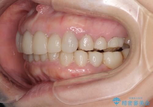 この際全てをしっかりと治療したい 総合歯科治療の治療中