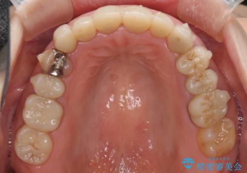この際全てをしっかりと治療したい 総合歯科治療の治療中