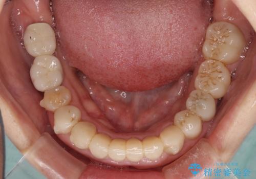 この際全てをしっかりと治療したい 総合歯科治療の治療中