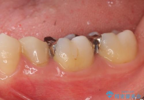 オールセラミッククラウン セラミックインレー 銀歯を白い歯への治療前