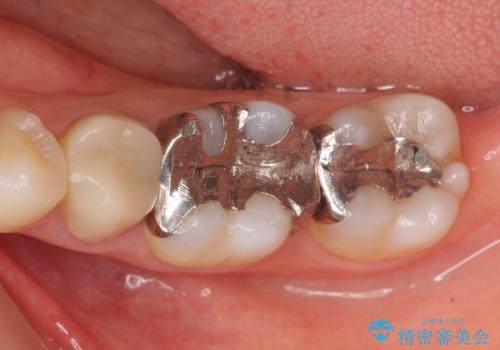 オールセラミッククラウン　セラミックインレー　銀歯を白い歯への症例 治療前