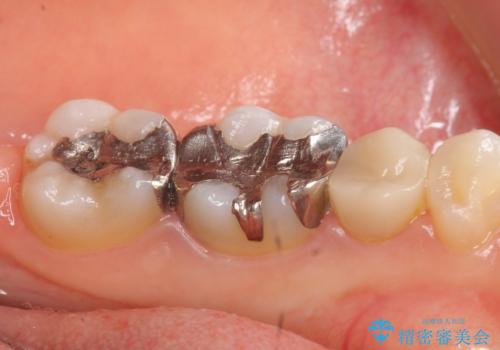 オールセラミッククラウン セラミックインレー 銀歯を白い歯への治療前