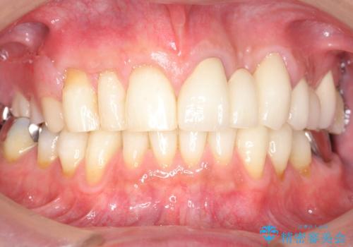 歯が折れた どうしても抜きたくない 歯の牽引で保存可能にの治療後