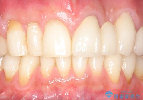 歯が折れた どうしても抜きたくない 歯の牽引で保存可能にの治療後