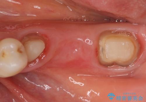 オールセラミッククラウン 欠損補綴と再生療法による深いポケットの改善の治療中