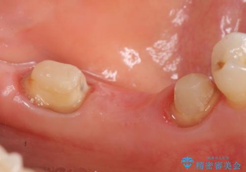 オールセラミッククラウン 欠損補綴と再生療法による深いポケットの改善の治療中